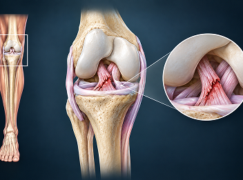 Treatment for knee ligament injuries (ACL/PCL)