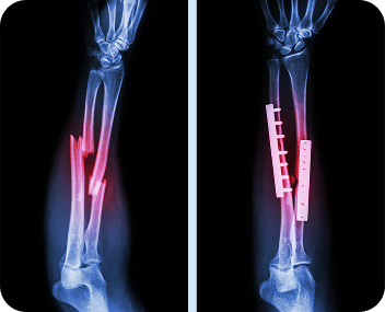 Treatment for bone injuries and fractures